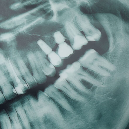 USP desenvolve IA que ajuda dentistas a detectar cáries em radiografias