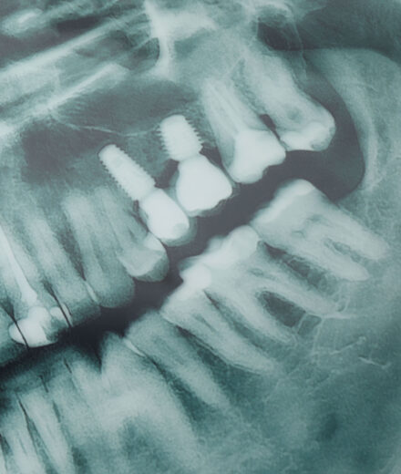 USP desenvolve IA que ajuda dentistas a detectar cáries em radiografias