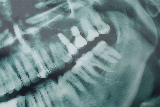 USP desenvolve IA que ajuda dentistas a detectar cáries em radiografias